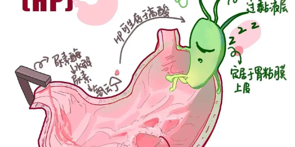 【必看】幽門螺桿菌真相揭示，別再忽視你的胃痛了！